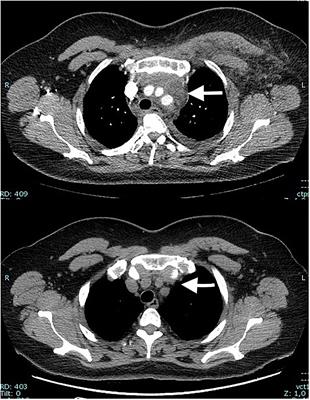 Case Report: Mediastinal Mass in SARS-COV-2 Pandemic: A Word of Caution